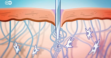 筋膜與針灸 筋膜與針灸