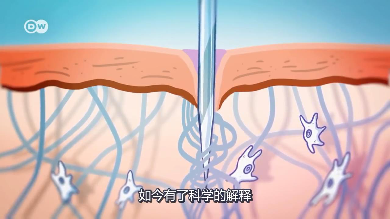 筋膜針灸 筋膜針灸