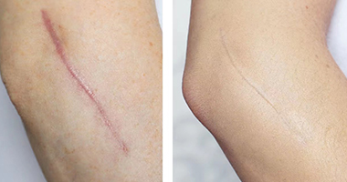 筋膜在傷口修復中的作用