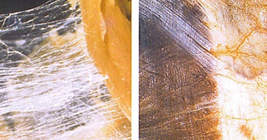 深筋膜在慢性疼痛與病理中的應用